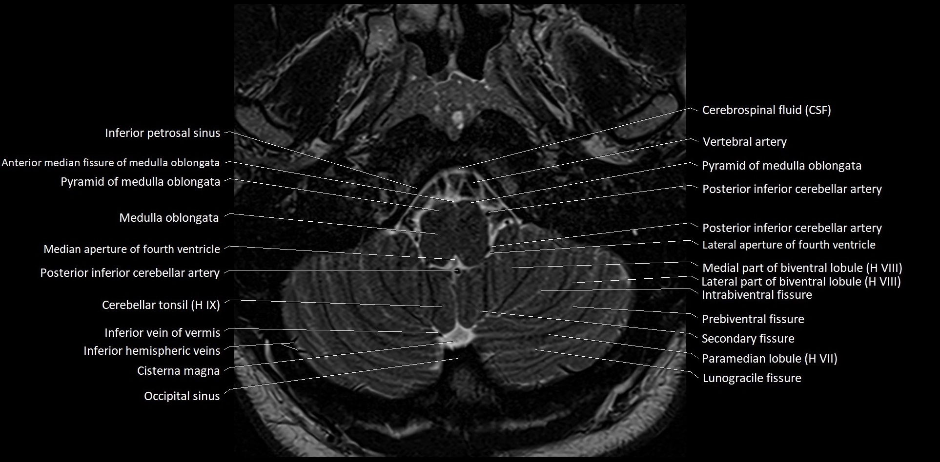 MRI Cerebellar anatomy High-resolution labelled 3T MRI image 5.webp